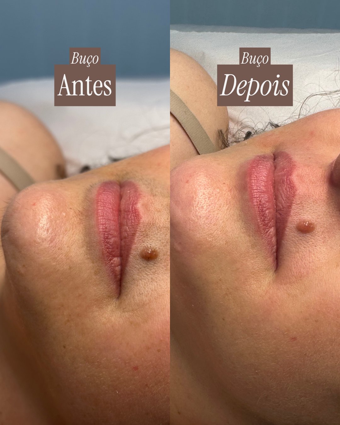 Antes e depois da epilação do buço