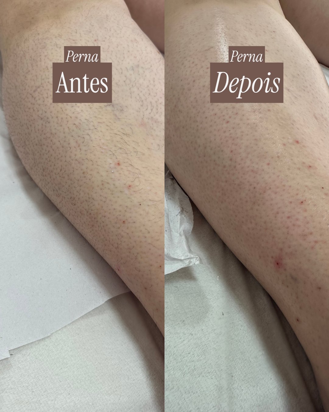 Antes e depois da epilação da perna